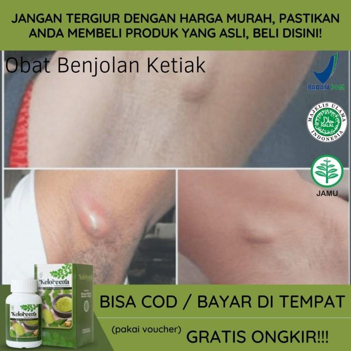 Cara Mengobati Benjolan di Paha Kanan: Panduan Lengkap 2 116a25c8b7676b5
