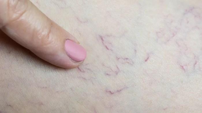 Cara Mengatasi Pembuluh Darah Pecah: Pencegahan, Diagnosis, dan Pengobatan 1 116a25c92ab8c00