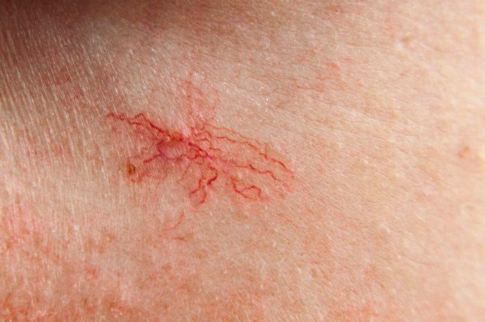 Cara Mengatasi Pembuluh Darah Pecah: Pencegahan, Diagnosis, dan Pengobatan 2 116a25c92b29bf7