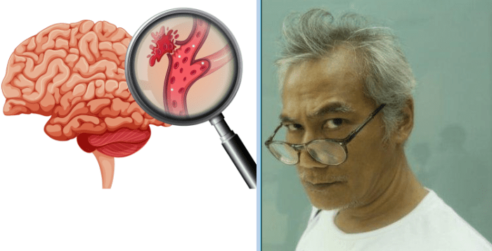 Cara Mengatasi Pembuluh Darah Pecah: Pencegahan, Diagnosis, dan Pengobatan 3 116a25c92b87fcb