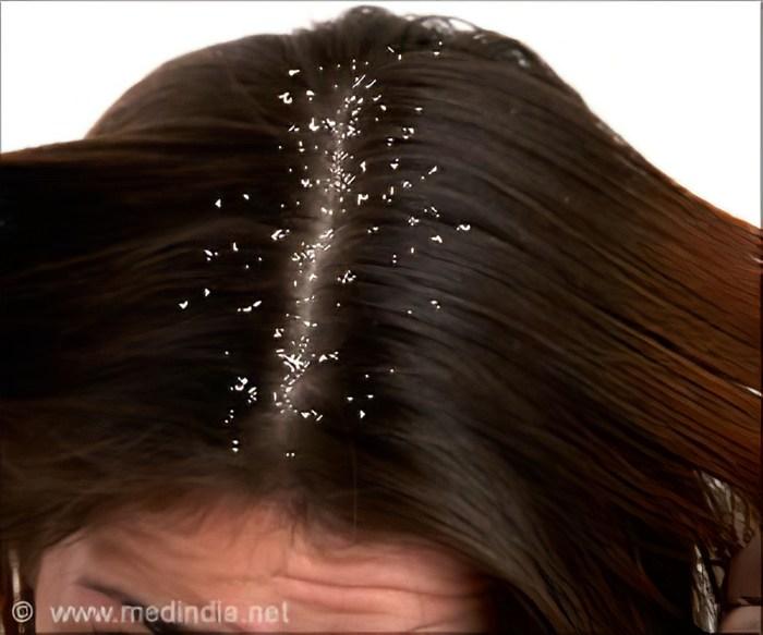 Cara Ampuh Basmi Ketombe, Rambut Sehat Bebas Gatal 1 116a25cda21a6b0